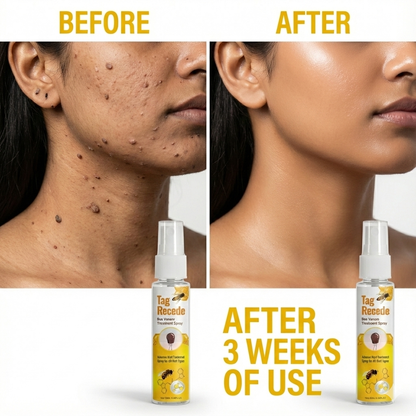 Wart & Maru (Skin Tag) Remover Spray - Buy 1 Get 1 FREE