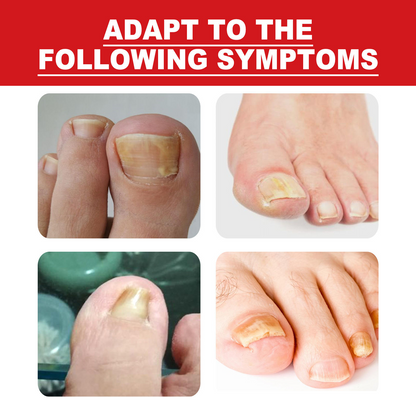 Southmoon Ingrown Toenail Drops Nail Repair Oil (BUY 1 GET 1 FREE🔥🔥)