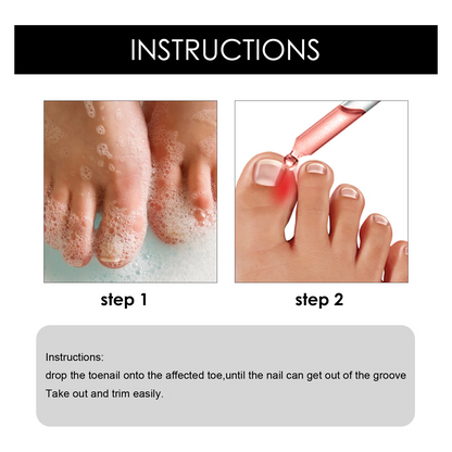 Southmoon Ingrown Toenail Drops Nail Repair Oil (BUY 1 GET 1 FREE🔥🔥)
