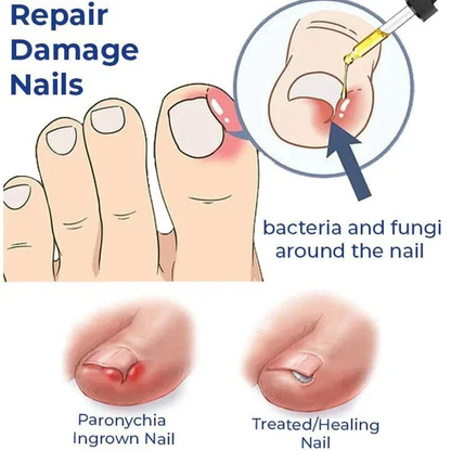 Anti Paronychia Relief Oil 🌿 - (Buy 1 Get 1 FREE🔥🔥)