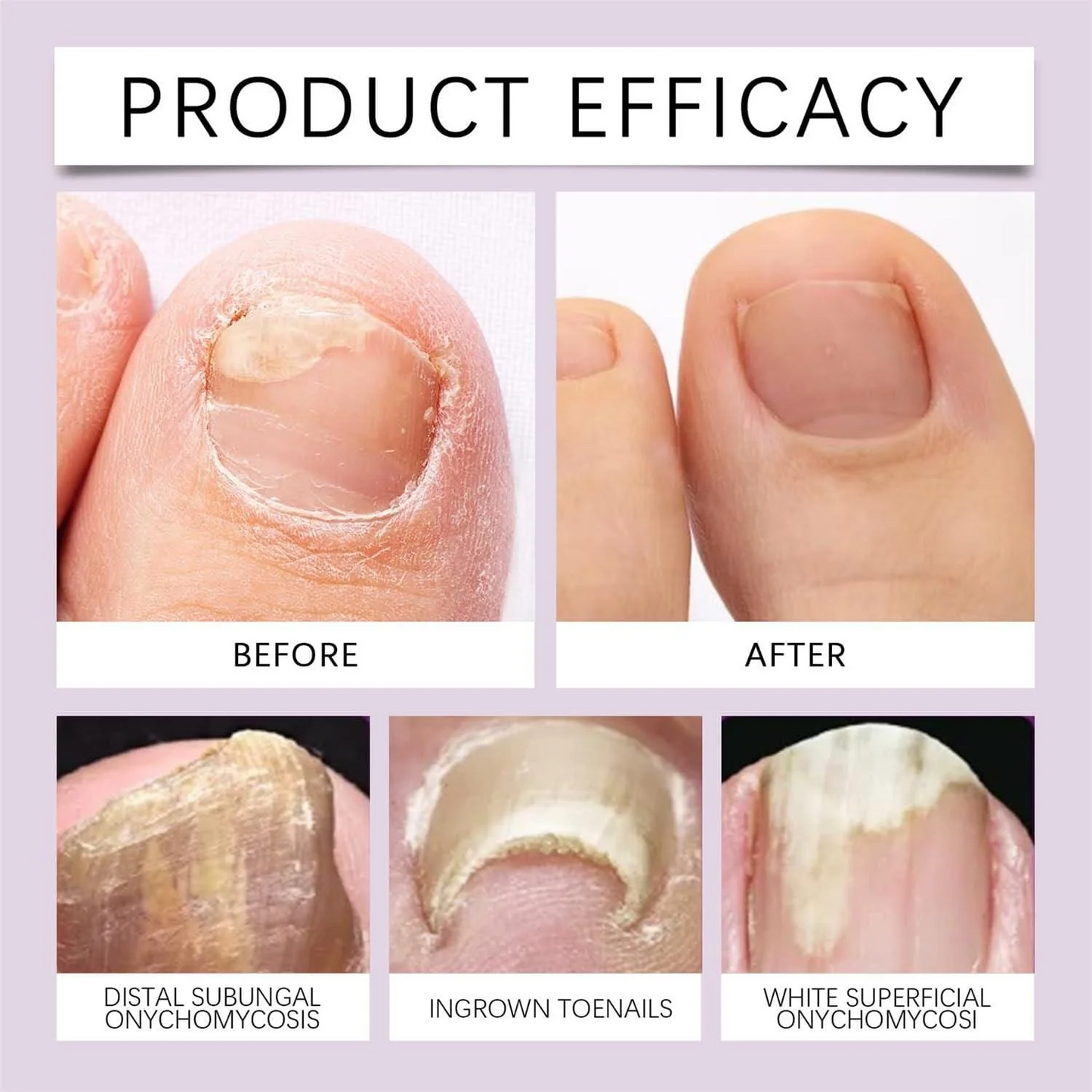 Bee Venom Nail Serum – Defeat Fungus, Restore Natural Shine