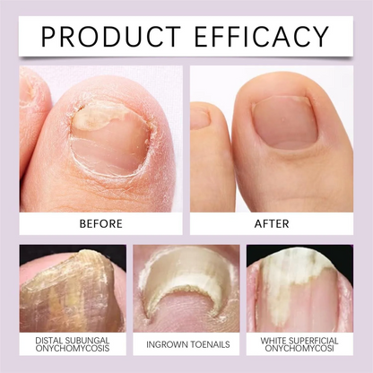 Bee Venom Nail Serum – Defeat Fungus, Restore Natural Shine