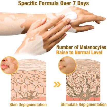 Bee Venom VitiGO Correcting Cream - Buy 1 Get 1 FREE🔥🔥