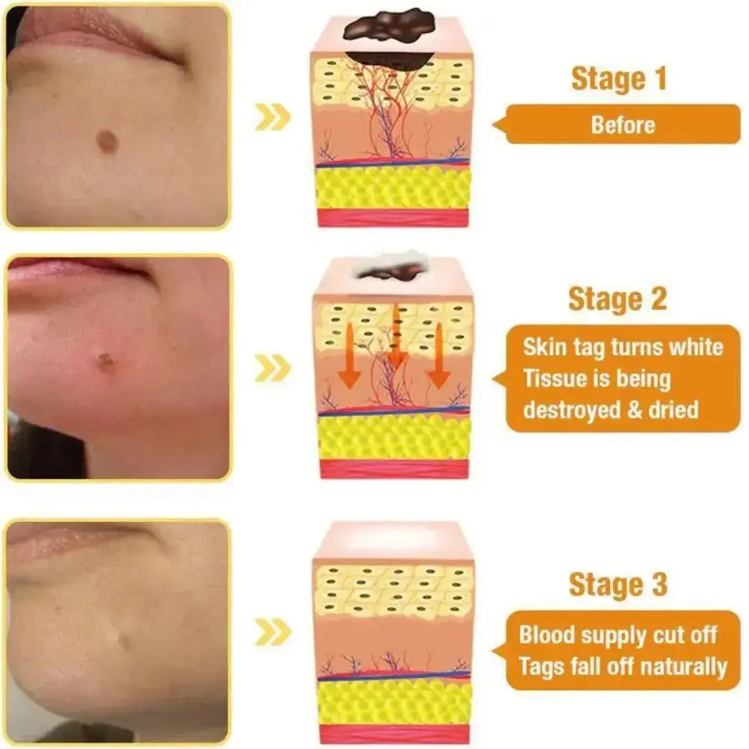 Wart & Skin Tags Remover Spray -  (Buy 1 Get 1 FREE🔥🔥)