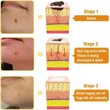 Wart & Skin Tags Remover Spray -  (Buy 1 Get 1 FREE🔥🔥)